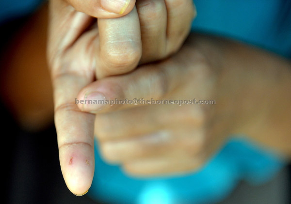  Norhayati menunjukkan kesan gigi-tan kucing di jari telunjuknya. — Gambar Bernama