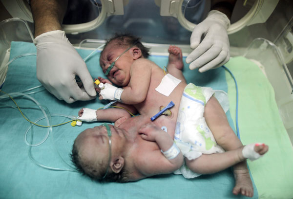  Kembar siam Palestin yang baharu sehari dilahirkan ditempatkan dalam inkubator di nurseri Hospital al-Shifa di Kota Gaza, kelmarin. — Gambar AFP