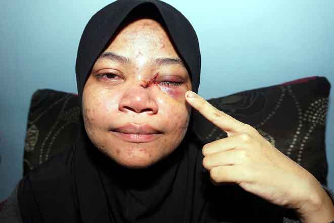  Nur Fatihah menunjukkan kecederaan yang dialami di kelopak mata hingga pangkal hidung akibat dipercayai terkena peluru sesat di rumahnya di Kampung Bukit Jambul di dekat Pendang, semalam. — Gambar Bernama