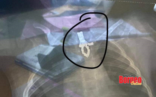  Gambar X-Ray menunjukkan kerongsang yang ditelan anak Nurul Asmah.