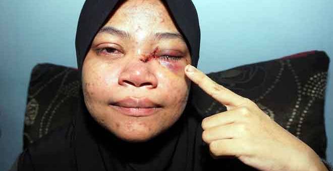 CEDERA: Nur Fatihah menunjukkan kecederaan yang dialami di kelopak mata hingga pangkal hidung akibat dipercayai terkena peluru sesat di rumahnya di Kampung Bukit Jambul di dekat Pendang, semalam. — Gambar Bernama