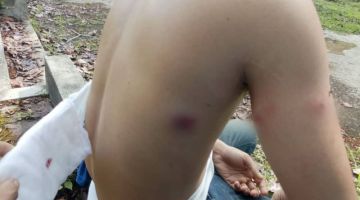 CEDERA: Keadaan kecederaan mangsa selepas ditembak oleh suspek di sebuah taman perumahan di Luyang, Kota Kinabalu.